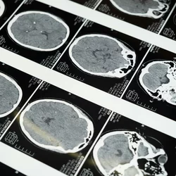 Brain MRI scane